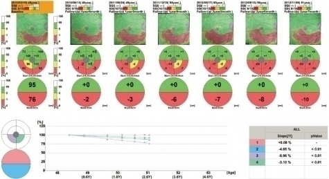 青光眼進程 青光眼進程